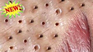 Amazing Blackheads Remover on the Face #010