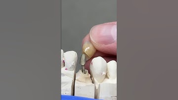 Post/Core Crown #dental #teeth #smile #lsk121shorts #shortvideo #shorts