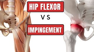 Get the Right Diagnosis: FAI (Impingement) or Hip Flexor Strain?
