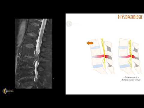 Vidéo: Rétrécissement Du Canal Vertébral Chez Les Chats