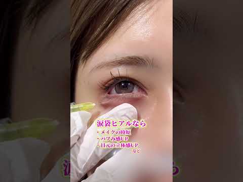 涙袋ヒアルロン酸で映える目元に✨#涙袋メイク #涙袋ヒアルロン酸 #涙袋
