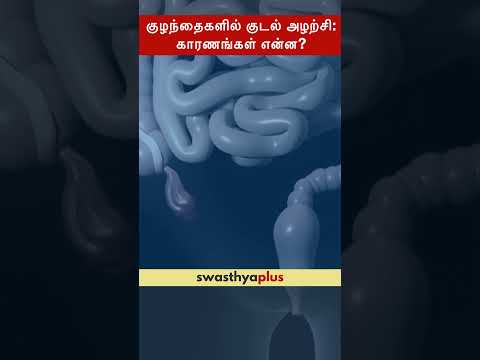 குழந்தைகளில் குடல் அழற்சி: காரணங்கள் என்ன? |Causes of Appendicitis in Children| Dr Siddharth Pandian