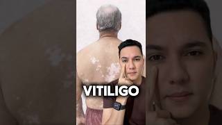 Le salvaron la vida de un cáncer de próstata pero desarrolló vitiligo. #dermatologowilliamguerrero