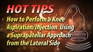 How to Perform a Knee Aspiration  and Injection Using a Suprapatellar Approach