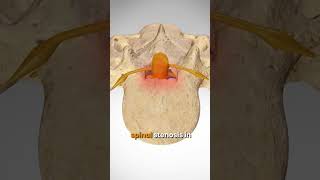 Stenosis: Part 1 | #backpainawareness #spinalhealth