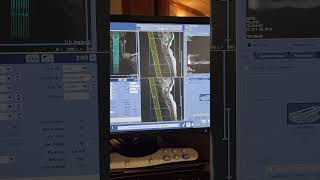 Cervical Spine MRI on a GE Voyager 1.5T scanner