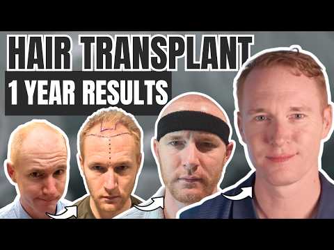 HAIR TRANSPLANT RESULTS: 1 Year of Progress / Month by Month Timeline