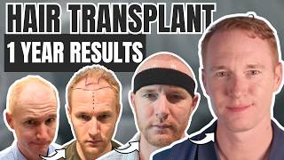 HAIR TRANSPLANT RESULTS: 1 Year of Progress / Month by Month Timeline
