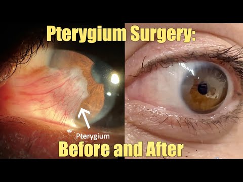 Ptergyium  Surgery - Before and After.  What is it?  How we remove it.  Recovery and Results.