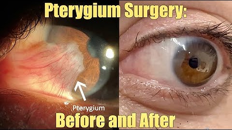 Ptergyium  Surgery - Before and After.  What is it?  How we remove it.  Recovery and Results.