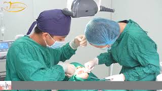 cam implant c ha