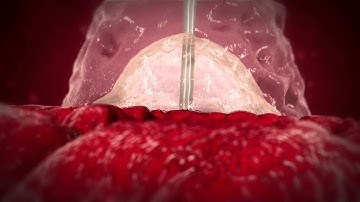 Mynx Ace Vascular Closure Device - Animation