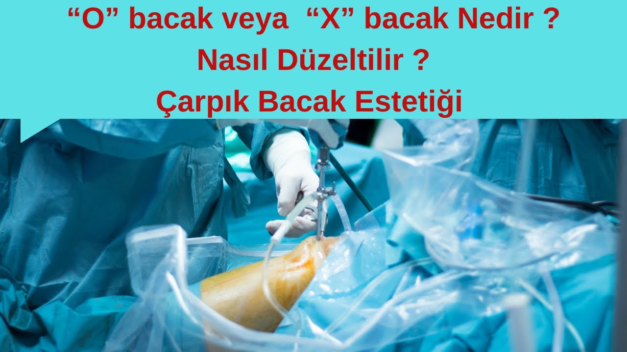 Bacak Eğriliği Ciddi Bir Problemdir ! | Çarpık Bacak  Estetiği   | Prof.Dr. Metin Küçükkaya