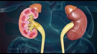 Kidney Stones 3d animation of Surgical procedure | causes, symptoms, Diagnosis, Treatment