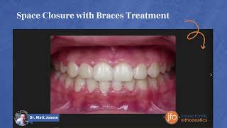 Closing Space with Braces Treatment | Joosse Family Orthodontics | Williamsburg, VA