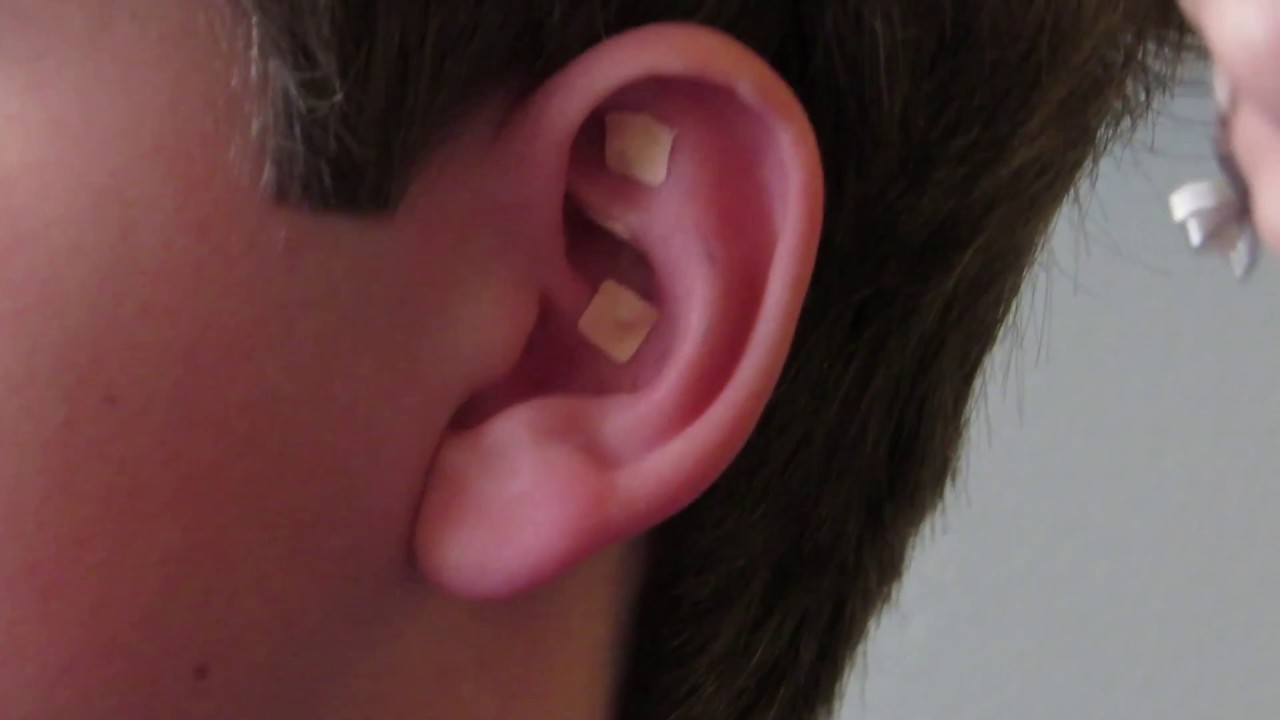 Ear seeds for stress relief - YouTube