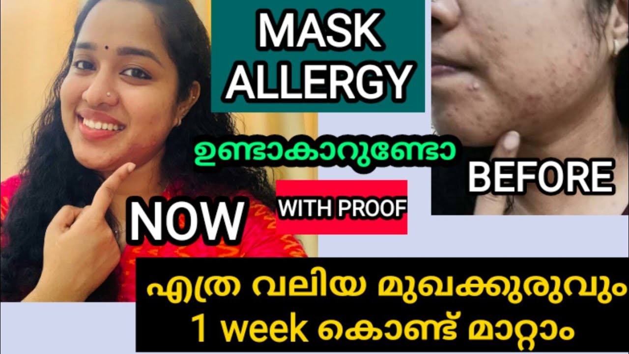 BEST REMEDY FOR MASK ALLERGY/Home remedy for acne