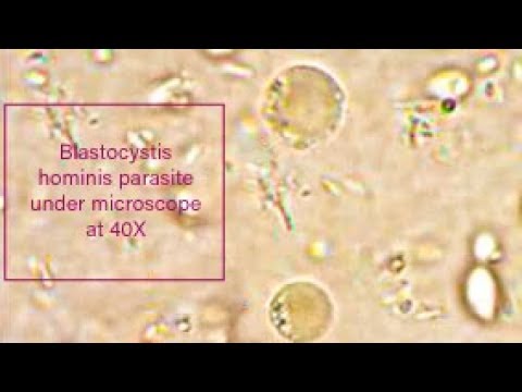 a blastocystosis parazita paraziták a felnőtt test tüneteiben