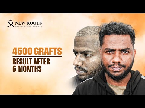 From Grade 5 Baldness to a NATURAL Hairline! 🔥 | Hair Transplant in Pune | Cost & Best Results