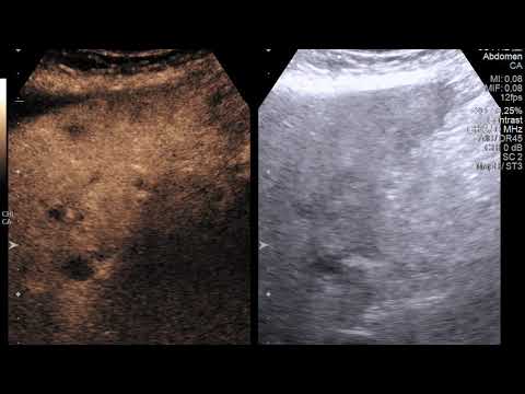 Video 3 - portal venous phase