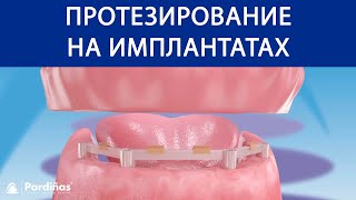 Протезирование на имплантатах ©