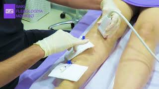Skleroterapiya Seansları Neçə Gündən Bir Oluna Bilər? - Dr. Ceyhun Hüseynov Bfm
