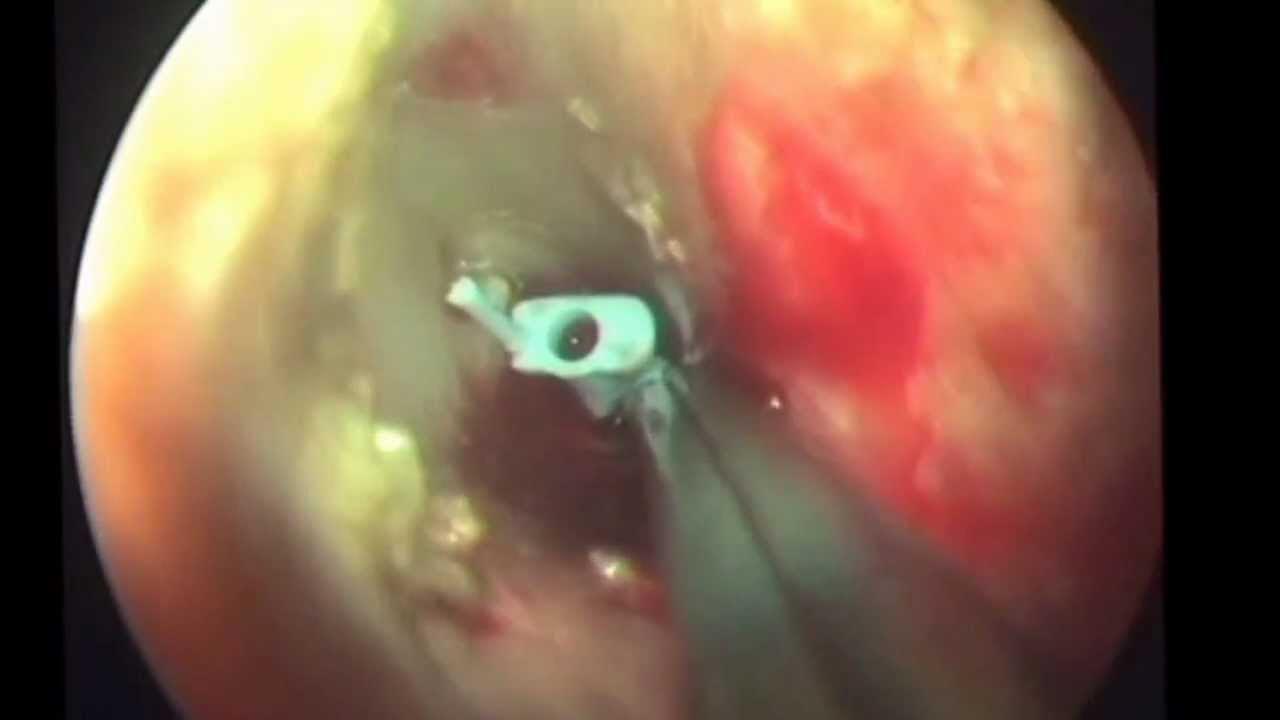 Myringotomy Grommet T Tube YouTube