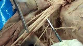 Brachial Plexus screenshot 2