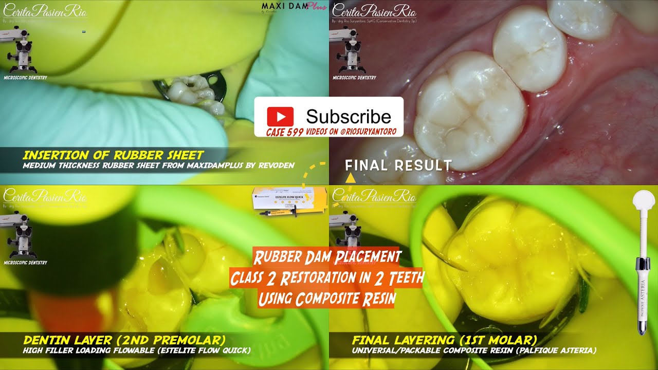 RUBBER DAM PLACEMENT & CLASS 2 COMPOSITE RESIN RESTORATION IN 2