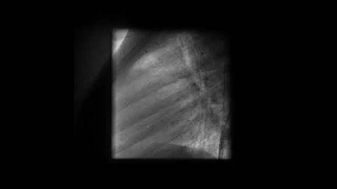 PDA Coil Closure Tiny PDA profiled