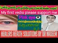 Conjunctivitis (Pink eye) treatment