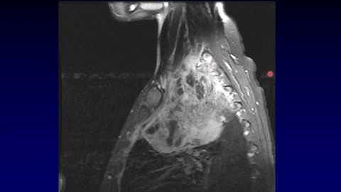 Brachial Plexus MRI, Part 2