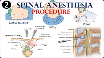 Spinal anesthesia (The procedure and approach)