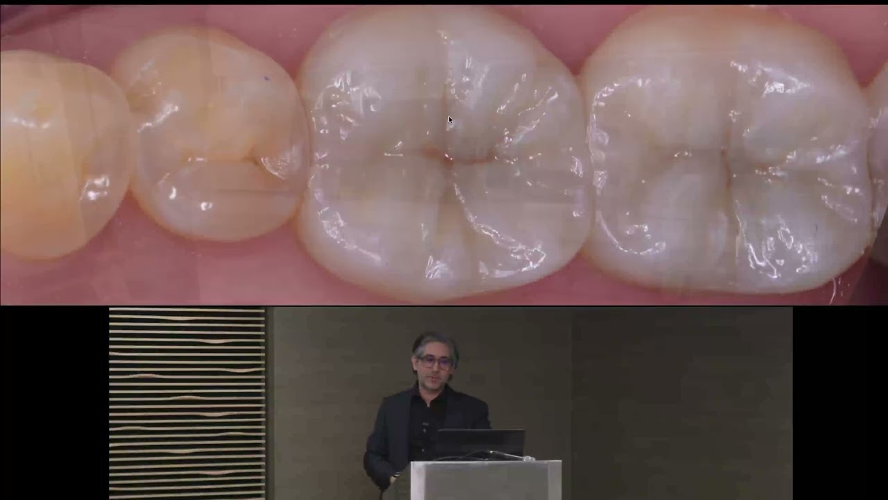 Bridging the Digital and Clinical: Accuracy in Implant Interface Solutions