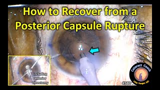 how to recover from a ruptured posterior capsule during cataract surgery
