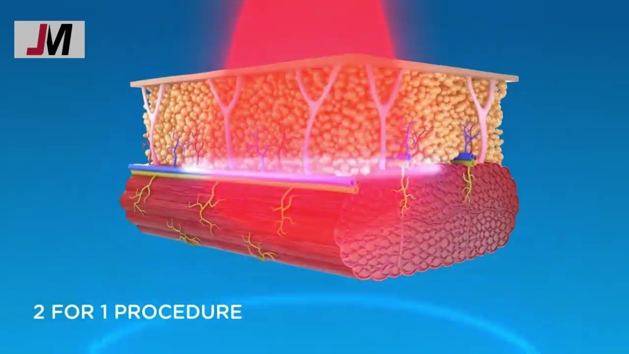 EMS- Sculpt body contouring