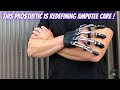 How Naked Prosthetics Is Redefining Amputee Care Around The World?