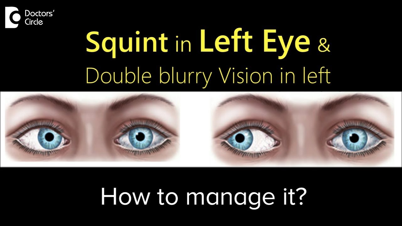 Management of Squint in Left Eye & Double blurry Vision in left?- Dr.  Sunita Rana Agarwal 