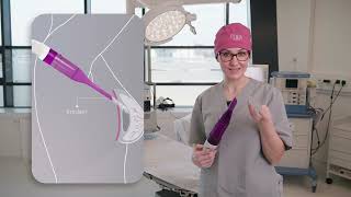 Minimal-Invasive Brustvergrösserung mit Mia Femtech™