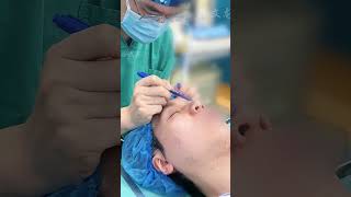 男生隆鼻也可以很好看Nose jobs for men can be aesthetically pleasing.#隆鼻 #鼻子 #男生