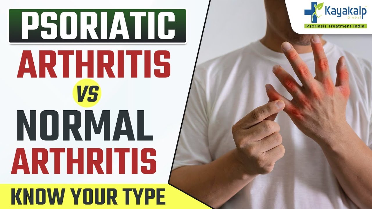Psoriatic Arthritis Vs Normal Arthritis Difference कैसे पता करे