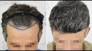 FUE Hair Transplant 3324 grafts Norwood III Vertex, Dr Bruno Pinto
