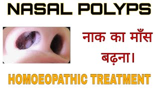 Nasal Polyps (नाक का मांस बढ़ना) की होम्योपैथिक दवाई । #homoeopathy #naslapolyp #viral