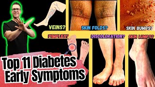 11 Early Type 2 Diabetes Symptoms in Your Feet!