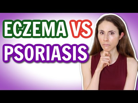 Video: Zijn psoriasis en eczeem hetzelfde?