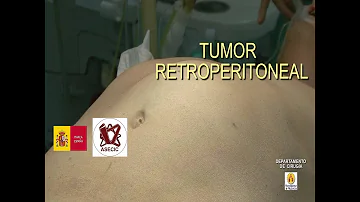 O que significa retroperitônio livre?