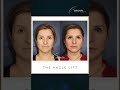 THE INVISIBLE SCARS OF THE ANGLE LIFT by Soler-Baillo Plastic Surgery