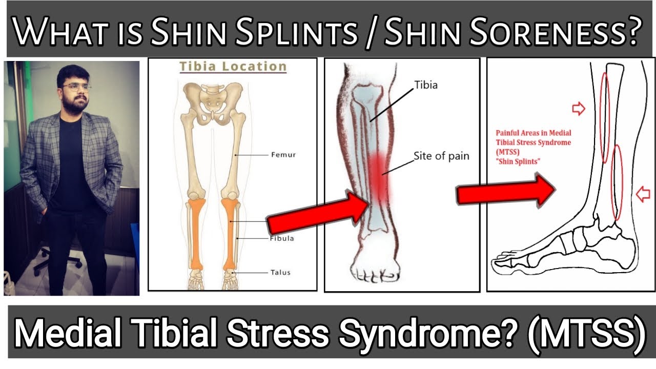 What is "Shin Splints"/ Shin Soreness? What is Medial Tibial Stress Syndrome ( MTSS