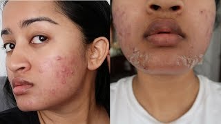 Acne Treatment Facial Peel What Did I Do To My Face?! SKIN UPDATE | SilasQiu