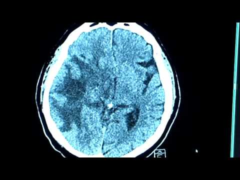 Video: Hirntumor-MRT-Erkennung mit Matlab - Gunook Video: Hirntumor-MRT-Erkennung mit Matlab - Gunook